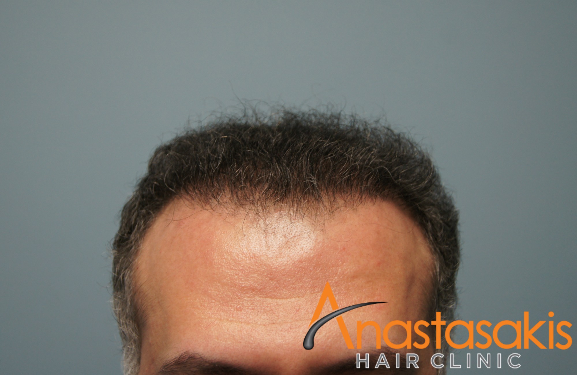 ασθενής μετά τη μεταμόσχευση μαλλιών με 2800fus hairline