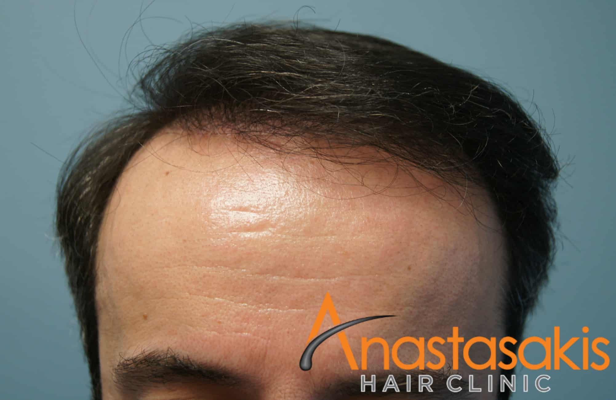 hairline ασθενους μετα τη μεταμοσχευση μαλλιων με 3300 fus