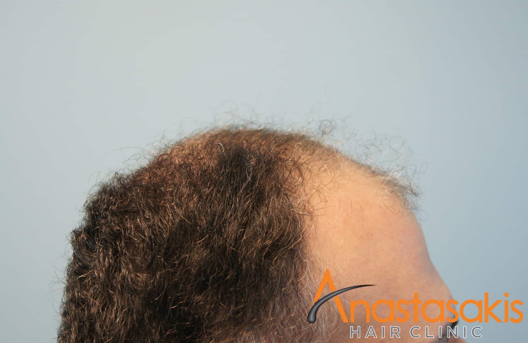 ασθενής πρίν τη μεταμόσχευση μαλλιών με 2800fus αριστερό προφίλ