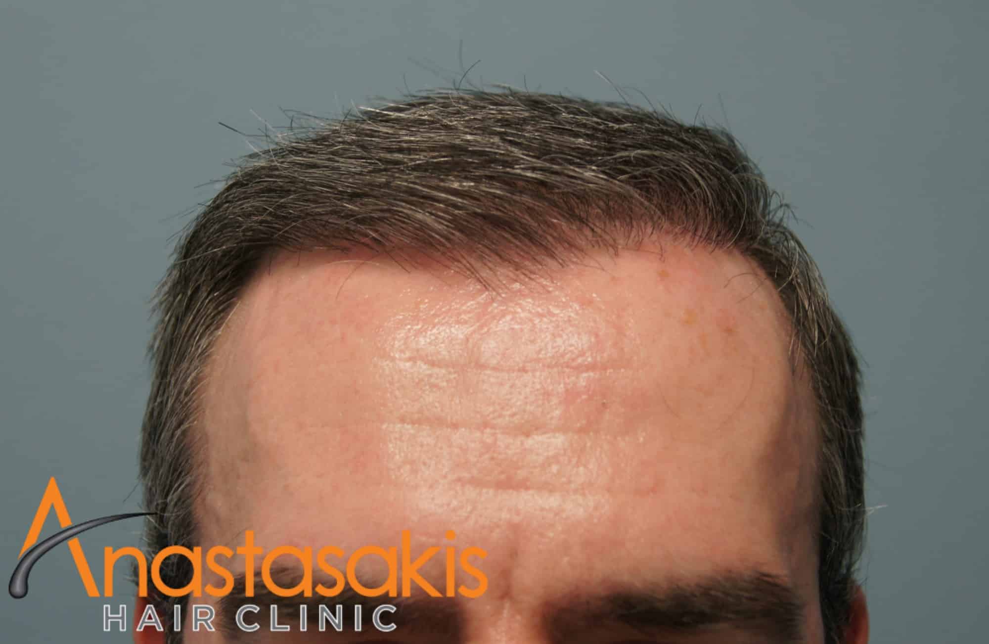 hairline ασθενους μετα τη μεταμοσχευση μαλλιων με 3050 fus