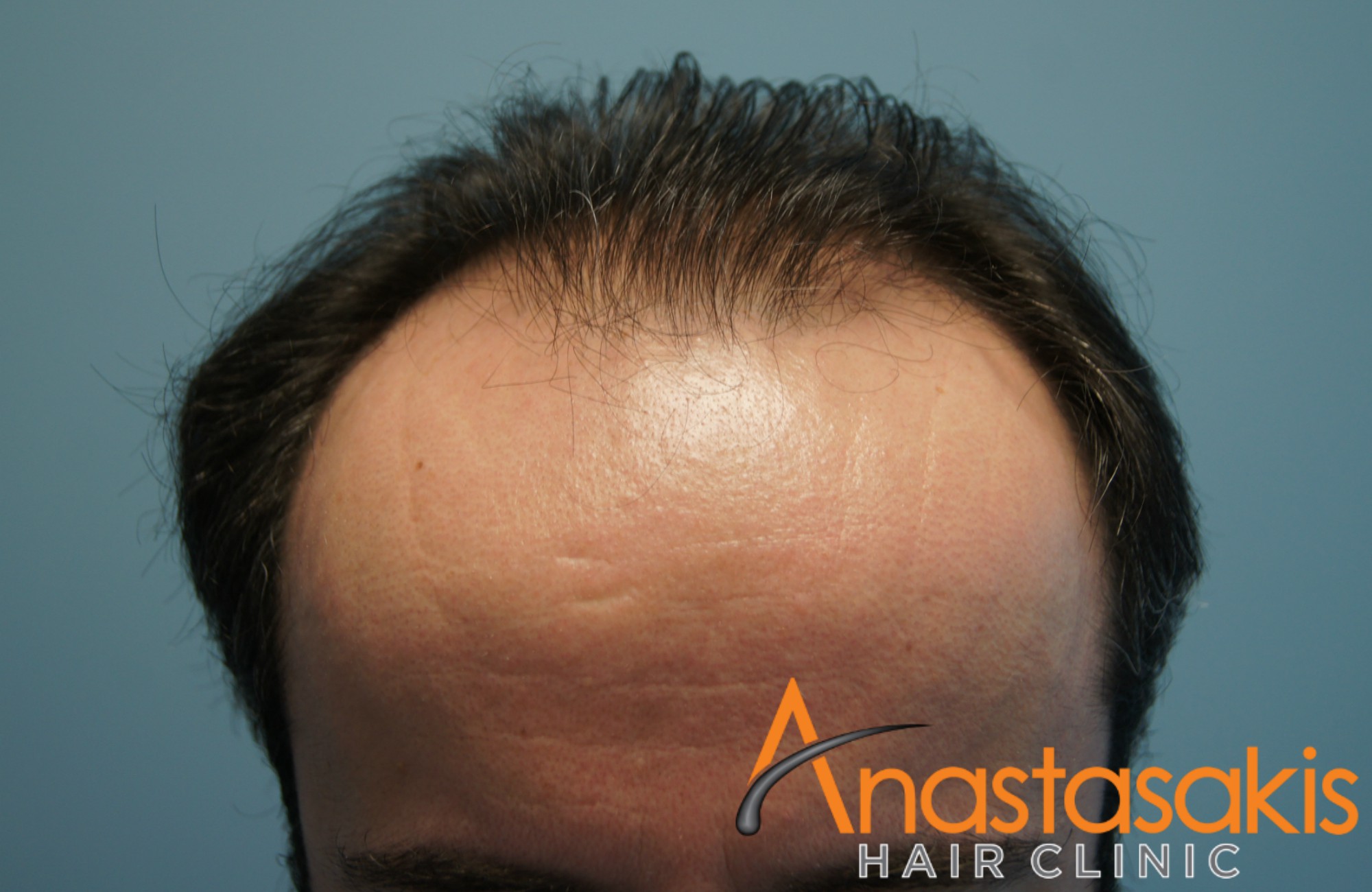 hairline ασθενους πριν τη μεταμοσχευση μαλλιων με 3300 fus