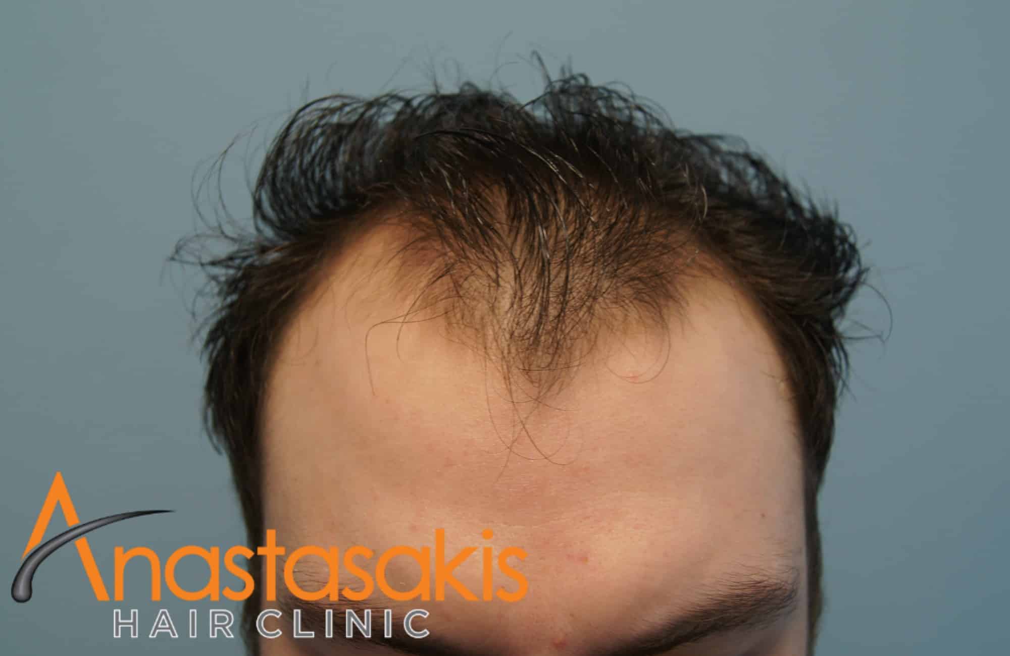 περιστατικό πριν επέμβασης μαλλιών fut με 1846fus hairline