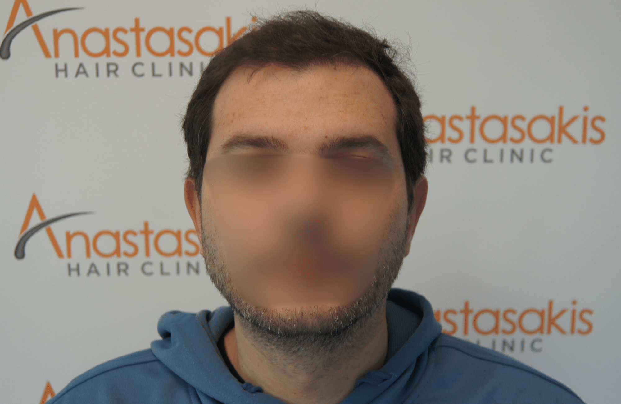 hair transplant result