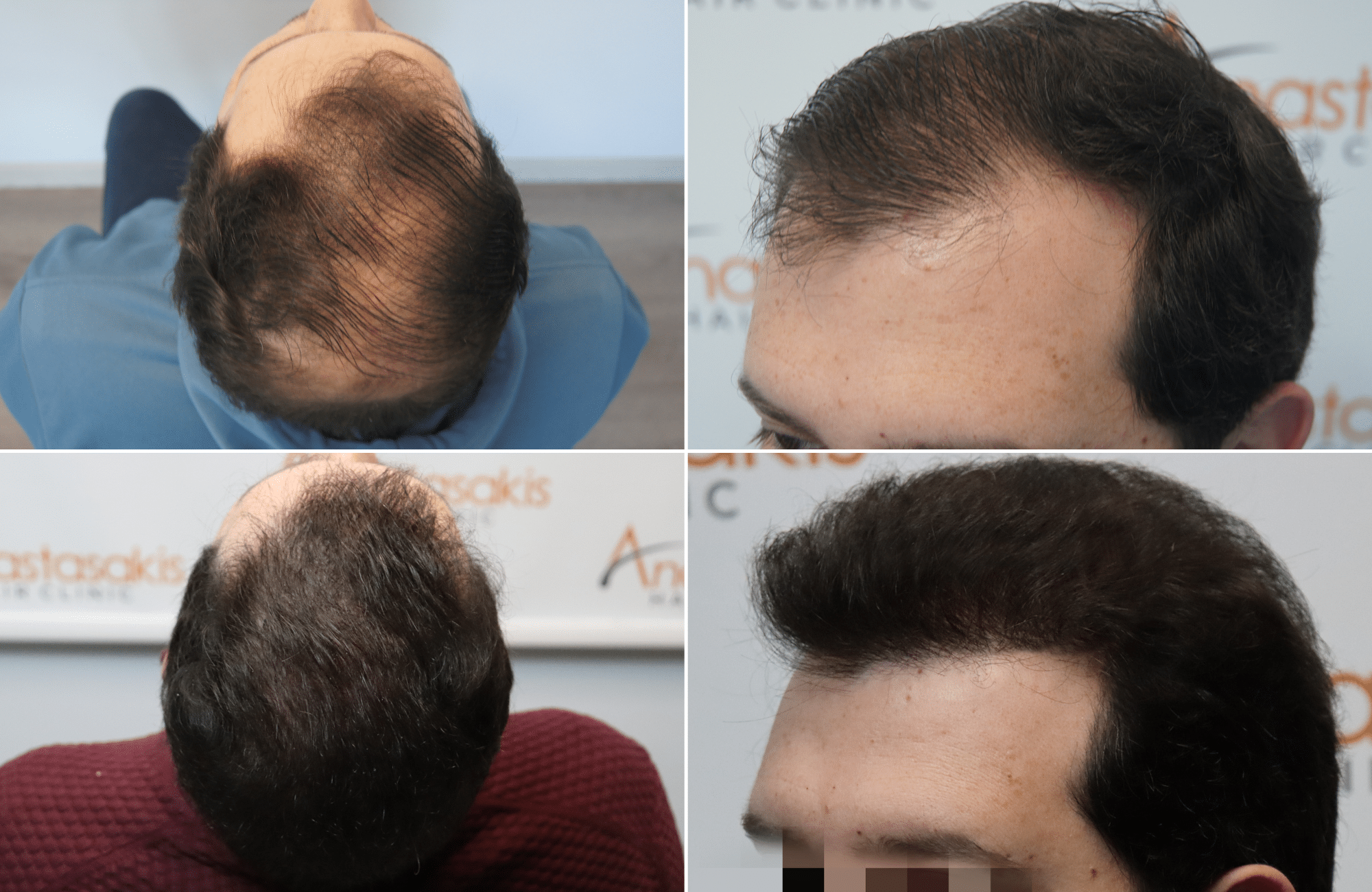 https://www.anastasakishairclinic.gr/portfolio/metamosxefsi-mallion-ahc-3050-fus-2/