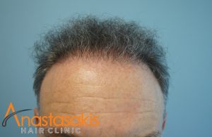 hairline ασθενή μετά τη μεταμόσχευση μαλλιών με 2700 fus
