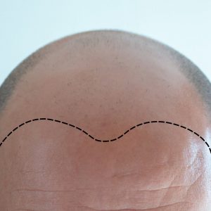 Hairline και Μεταμόσχευση Μαλλιών