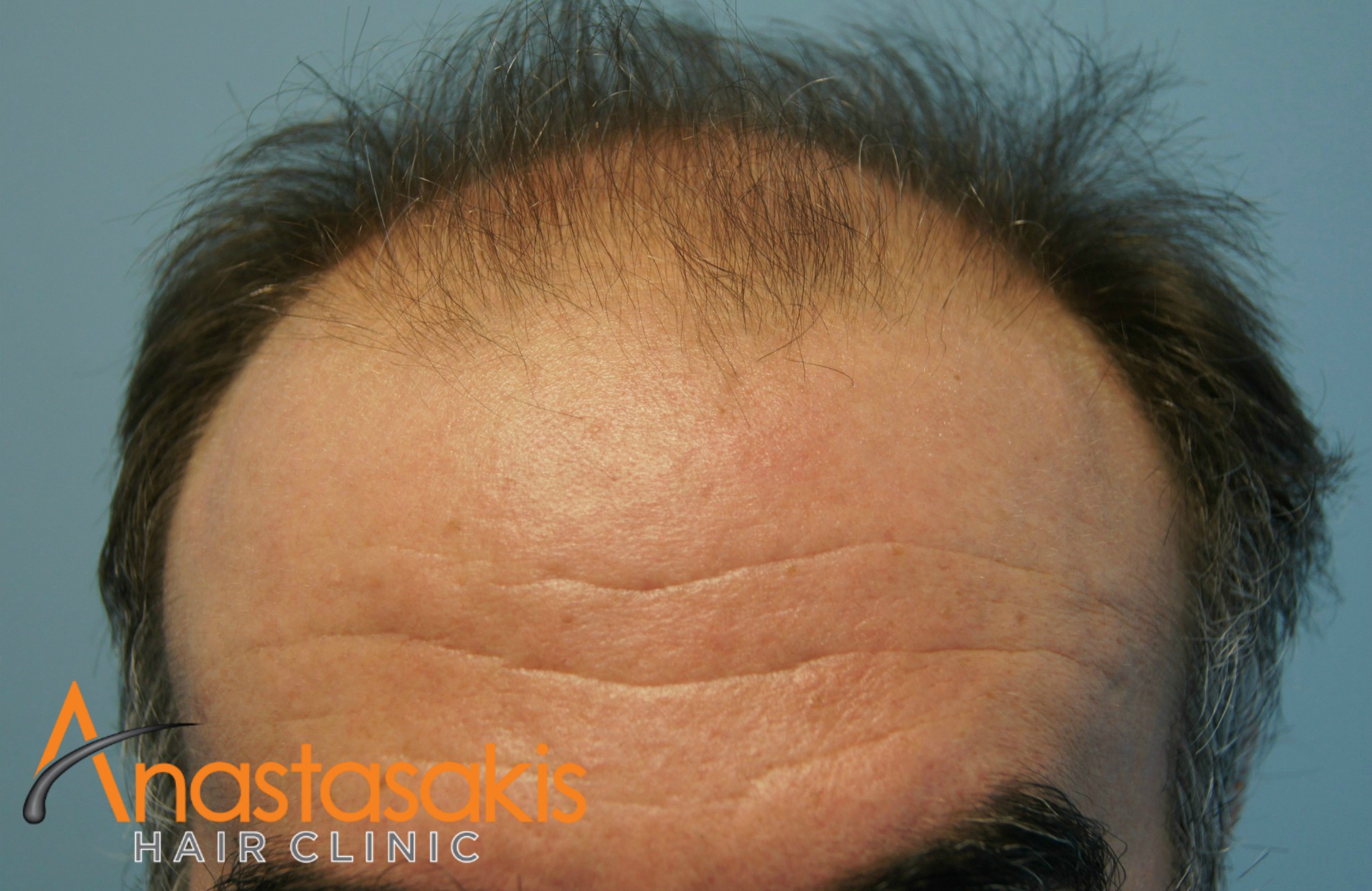 hairline ασθενη πριν την επέμβαση μαλλιών με 3110 fus
