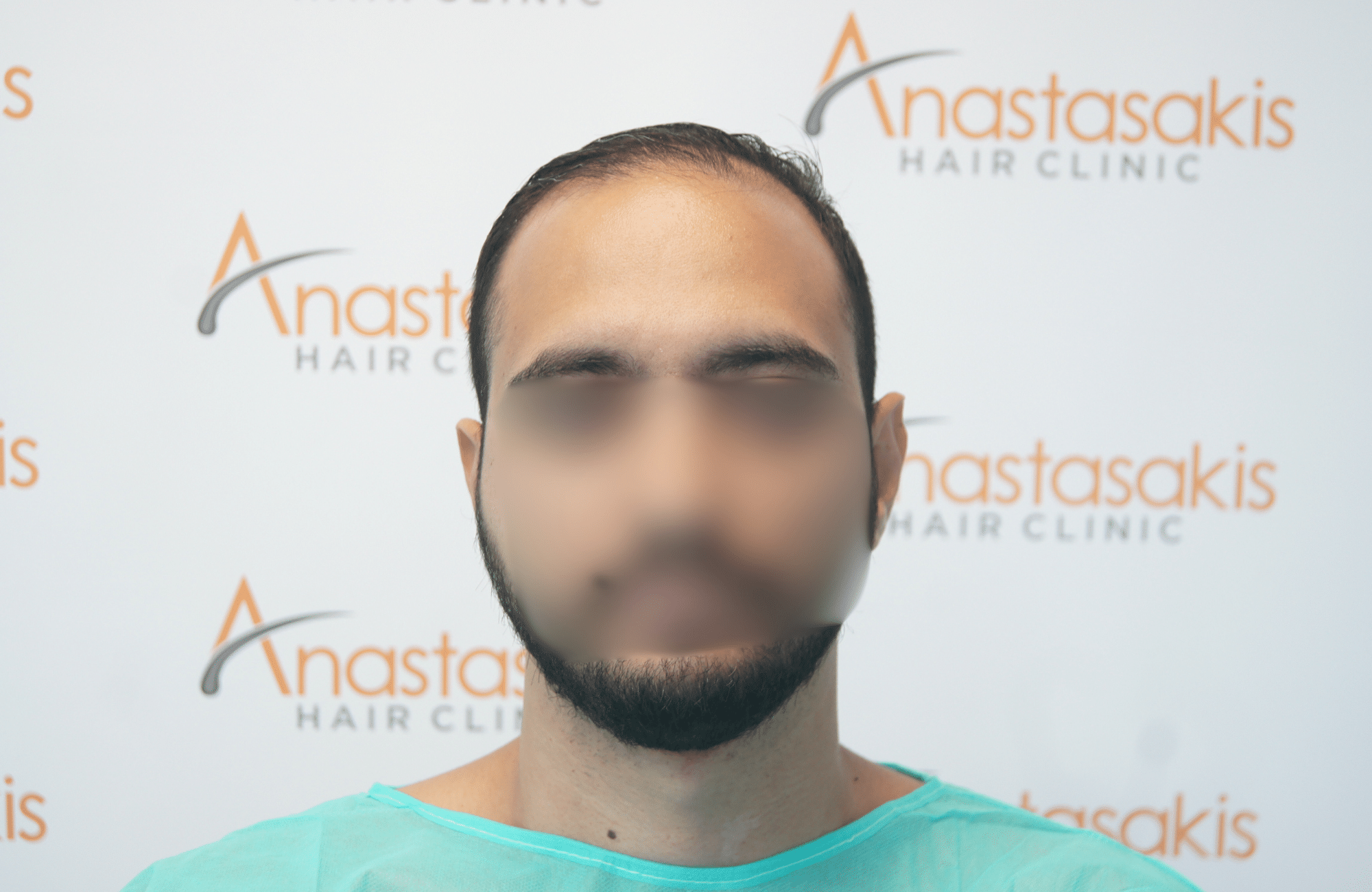 hair transplant result