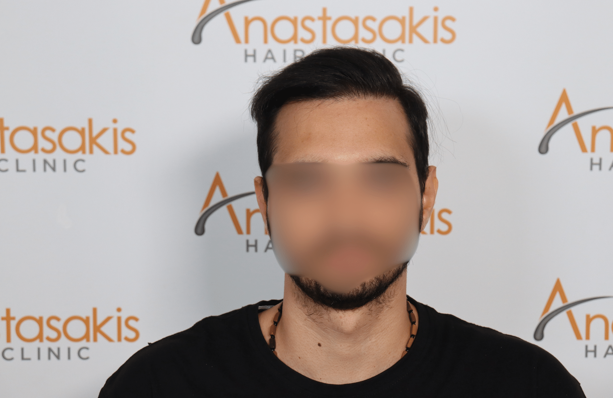 hair transplant result