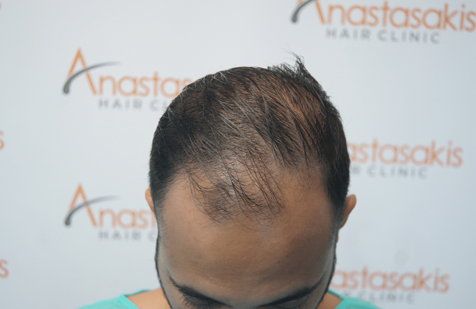 hair transplant result