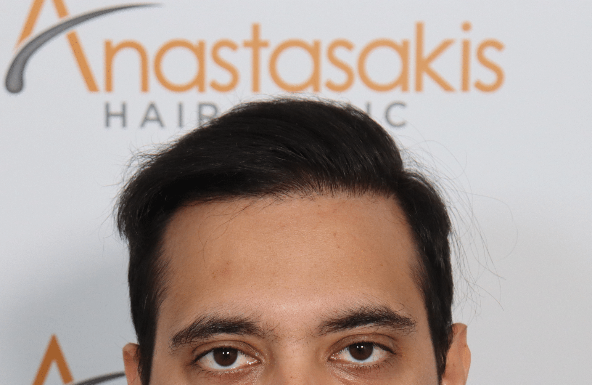 HAIR TRANSPLANT RESULT