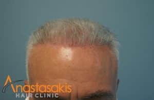 hairline ασθενή μετά τη εμφύτευση μαλλιών με 3500 fus