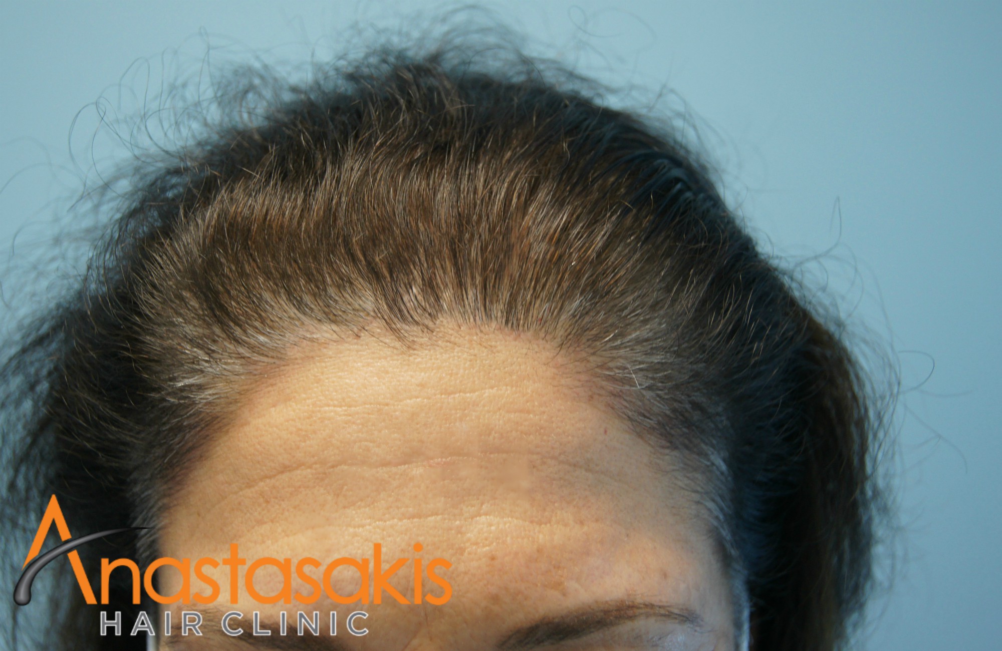 hairline γυναίκα ασθενής μετά την επέμβαση μαλλιών με 1500 fus
