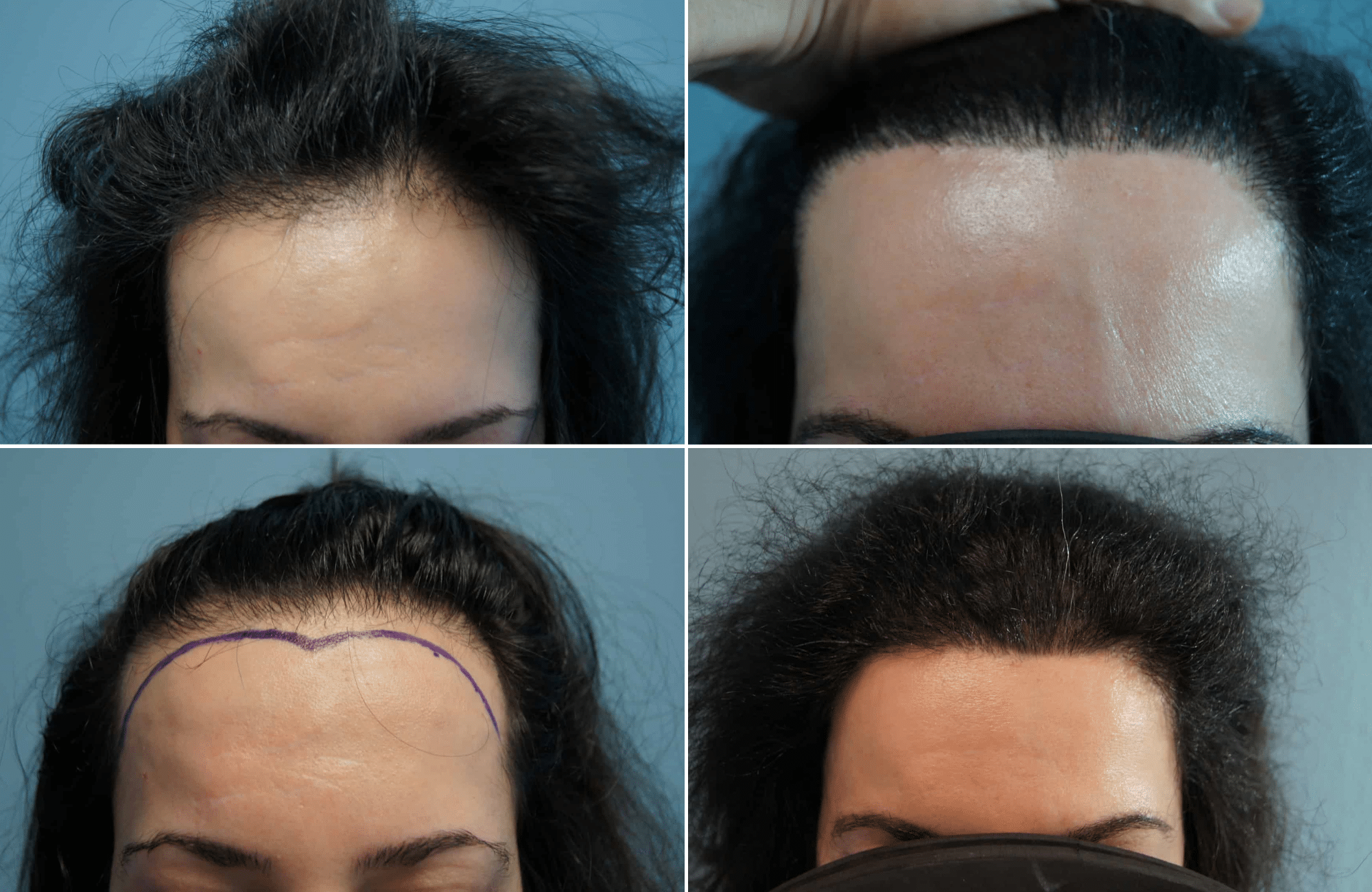 https://www.anastasakishairclinic.gr/portfolio/apotelesma-metamosxefsis-mallion-anastasakis-hair-clinic-268/