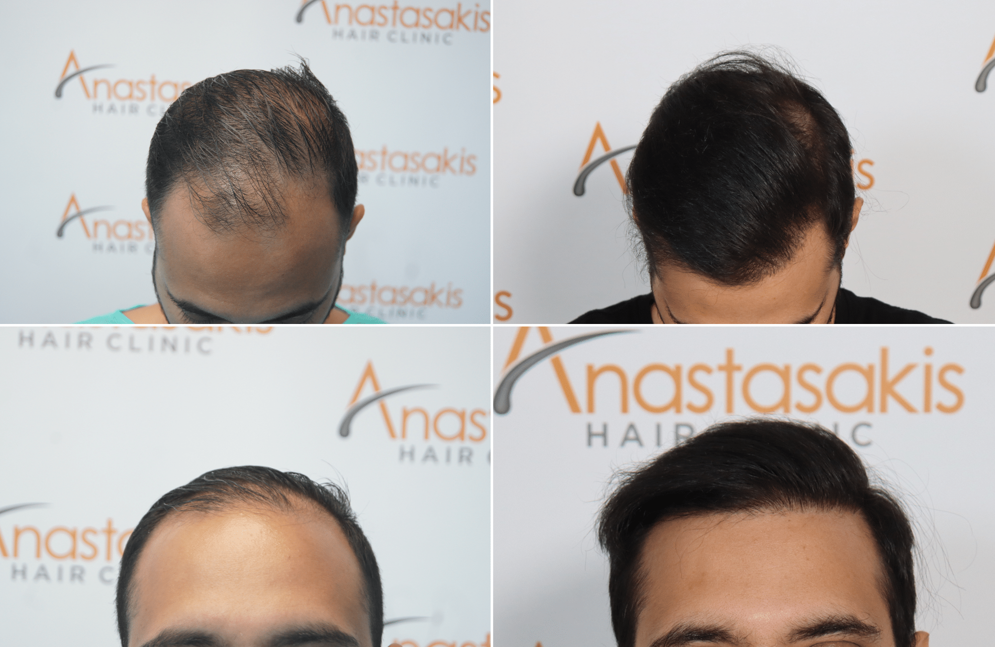 hair transplant result