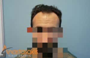fullface ασθενους πριν τη μεταμοσχευση μαλλιων με 1623 fus