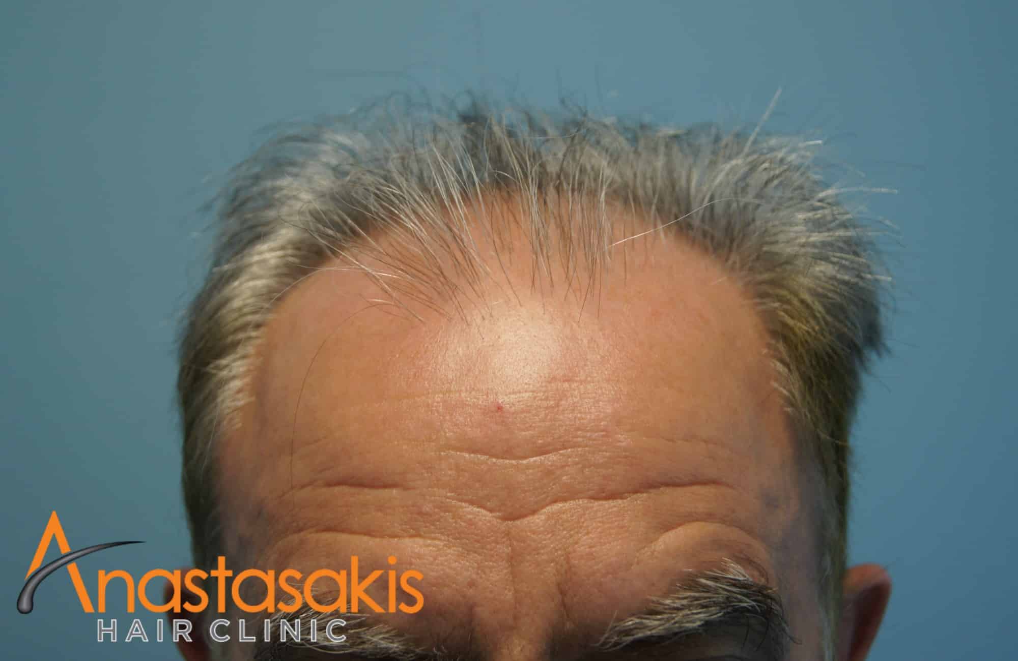 hairline ασθενους πριν τη μεταμοσχευση μαλλιων με 3650 fus
