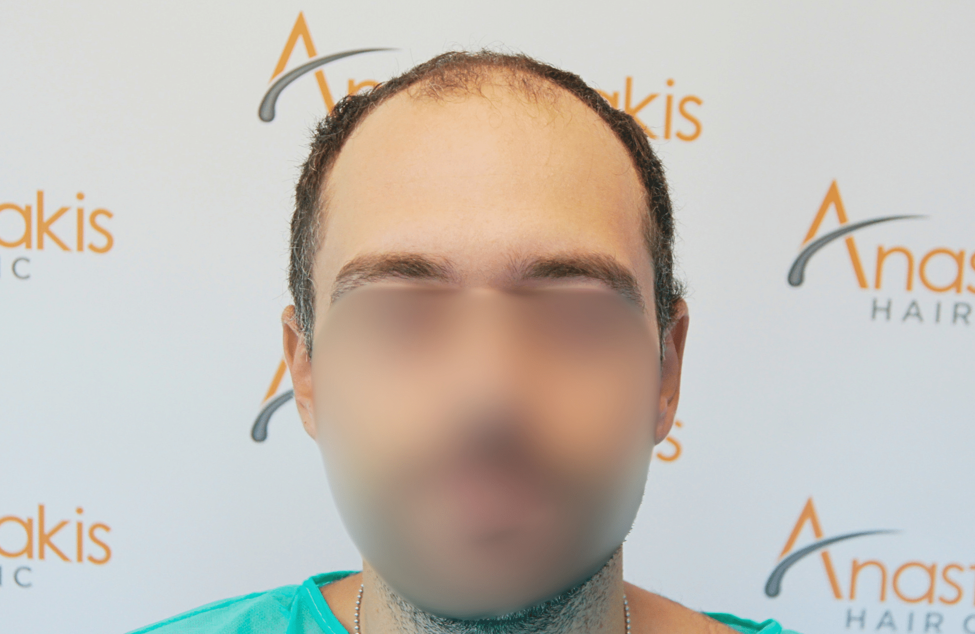 hair transplant result 2000 fus before