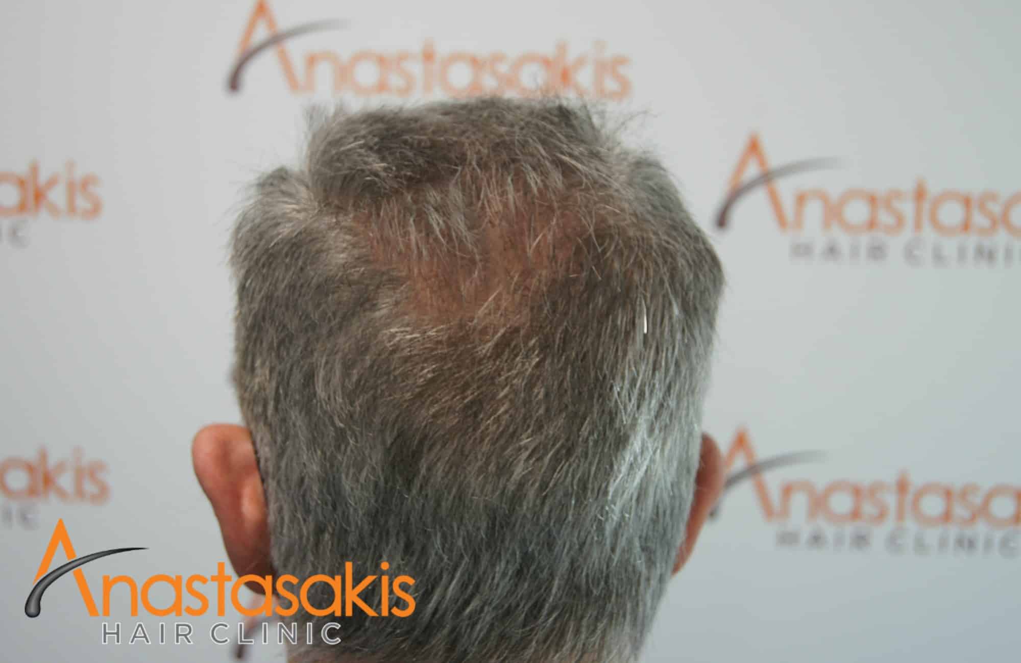 δοτρια περιοχη ασθενους μετα τη μεταμοσχευση μαλλιων με 3650 fus