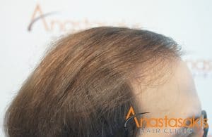 αριστερο προφιλ ασθενους μετα τη μεταμοσχευση μαλλιων με 3500 fus