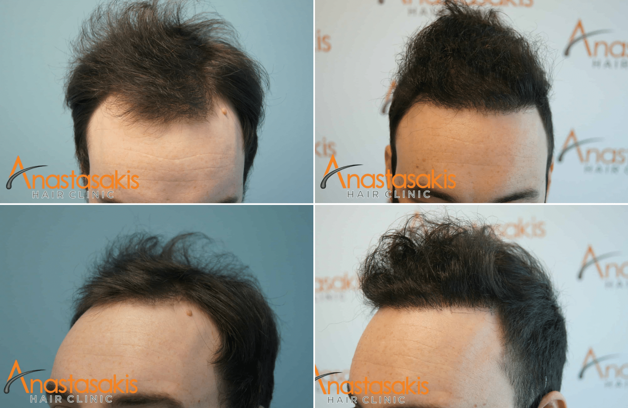 https://www.anastasakishairclinic.gr/portfolio/apotelesma-me-1300-fus-fue/