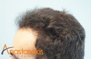 δεξι προφιλ ασθενους μετα τη μεταμοσχευση μαλλιων με 1623 fus