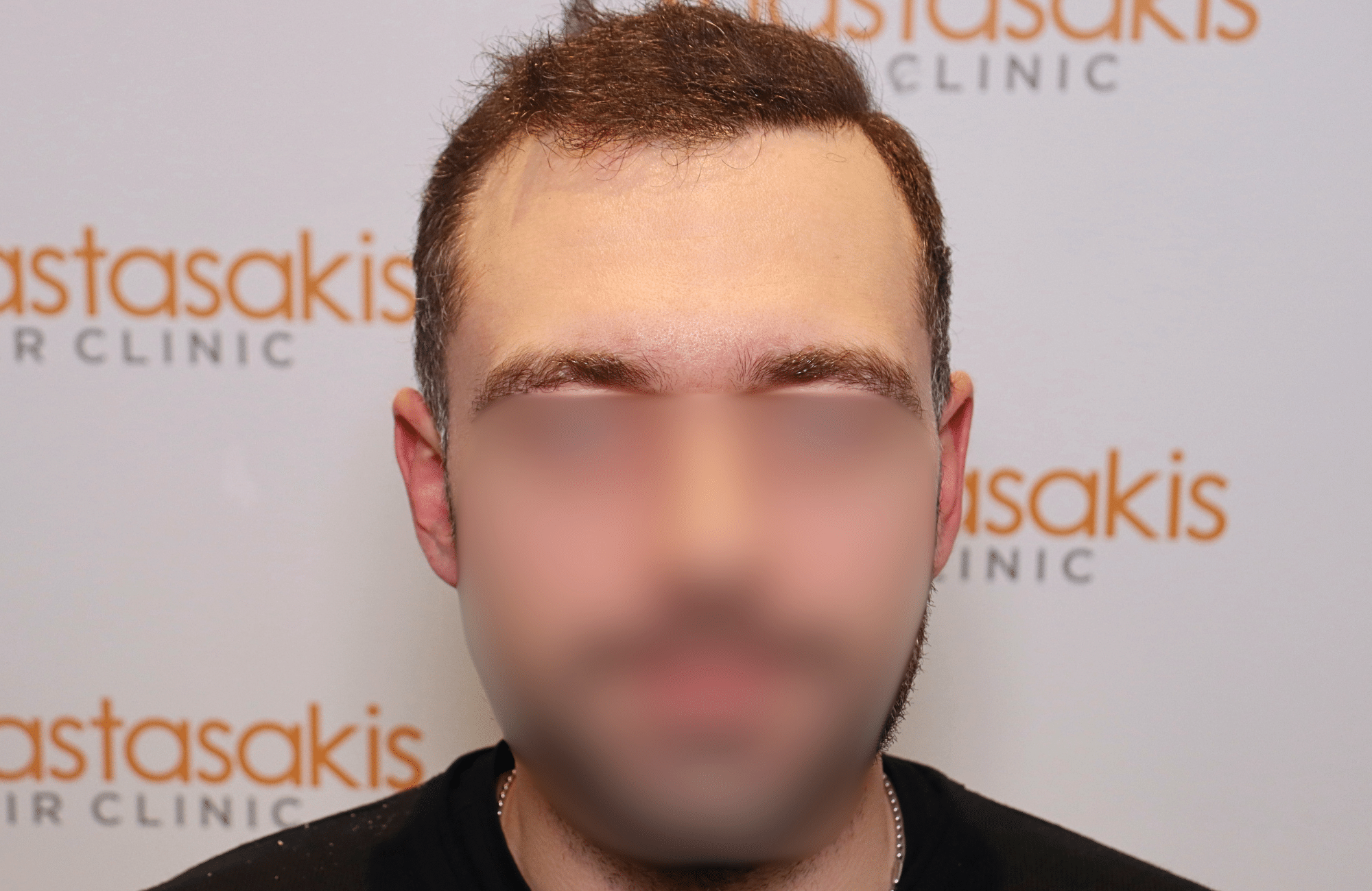 hair transplant result 2000 fus after