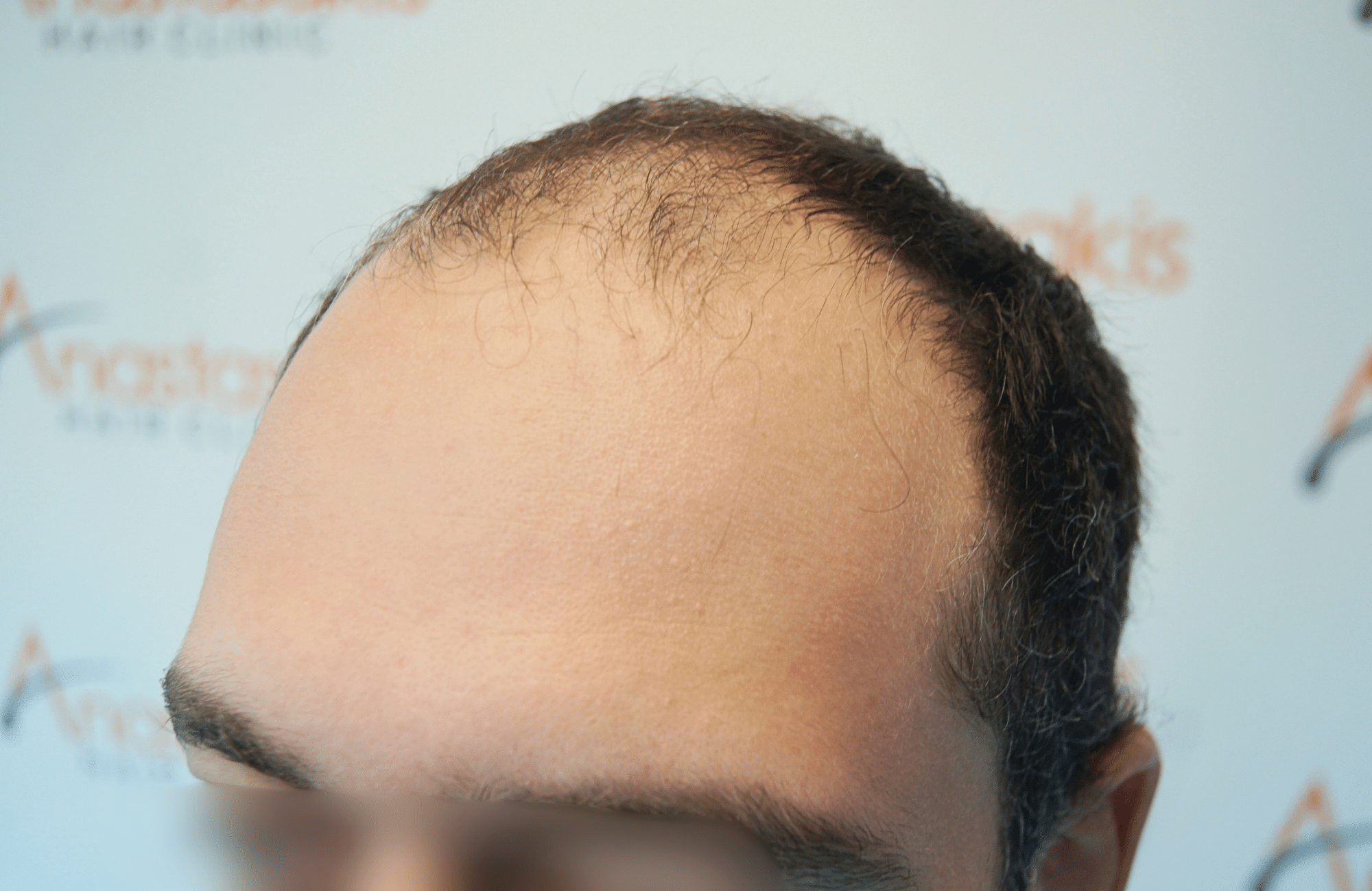 hair transplant result 2000 fus before