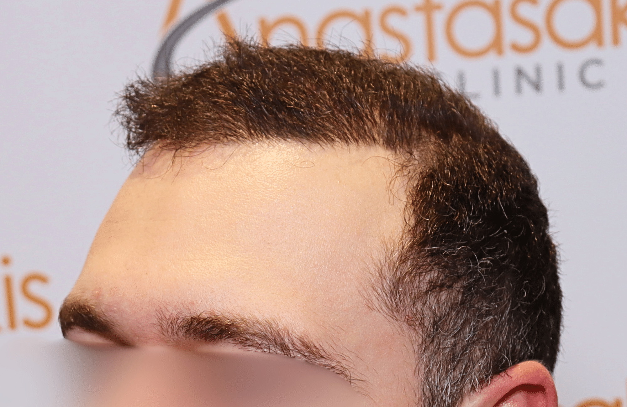 hair transplant result 2000 fus after