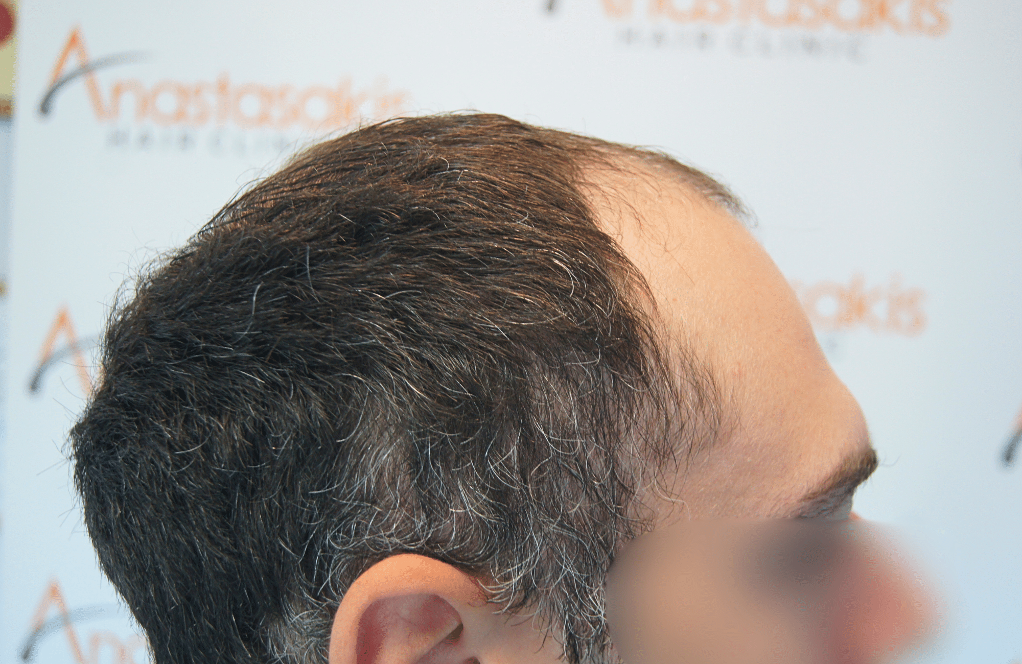hair transplant result 2000 fus before
