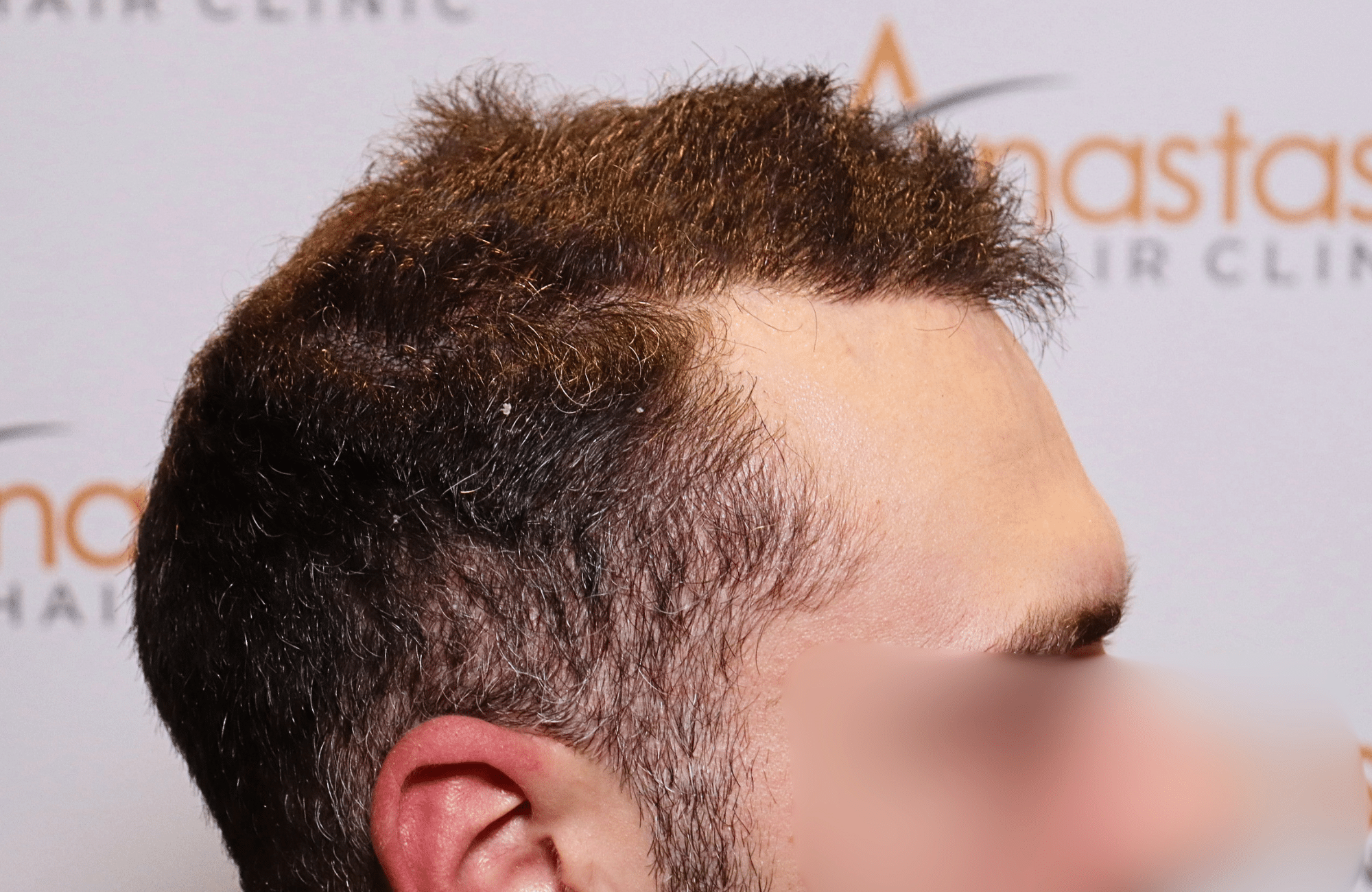 hair transplant result 2000 fus after