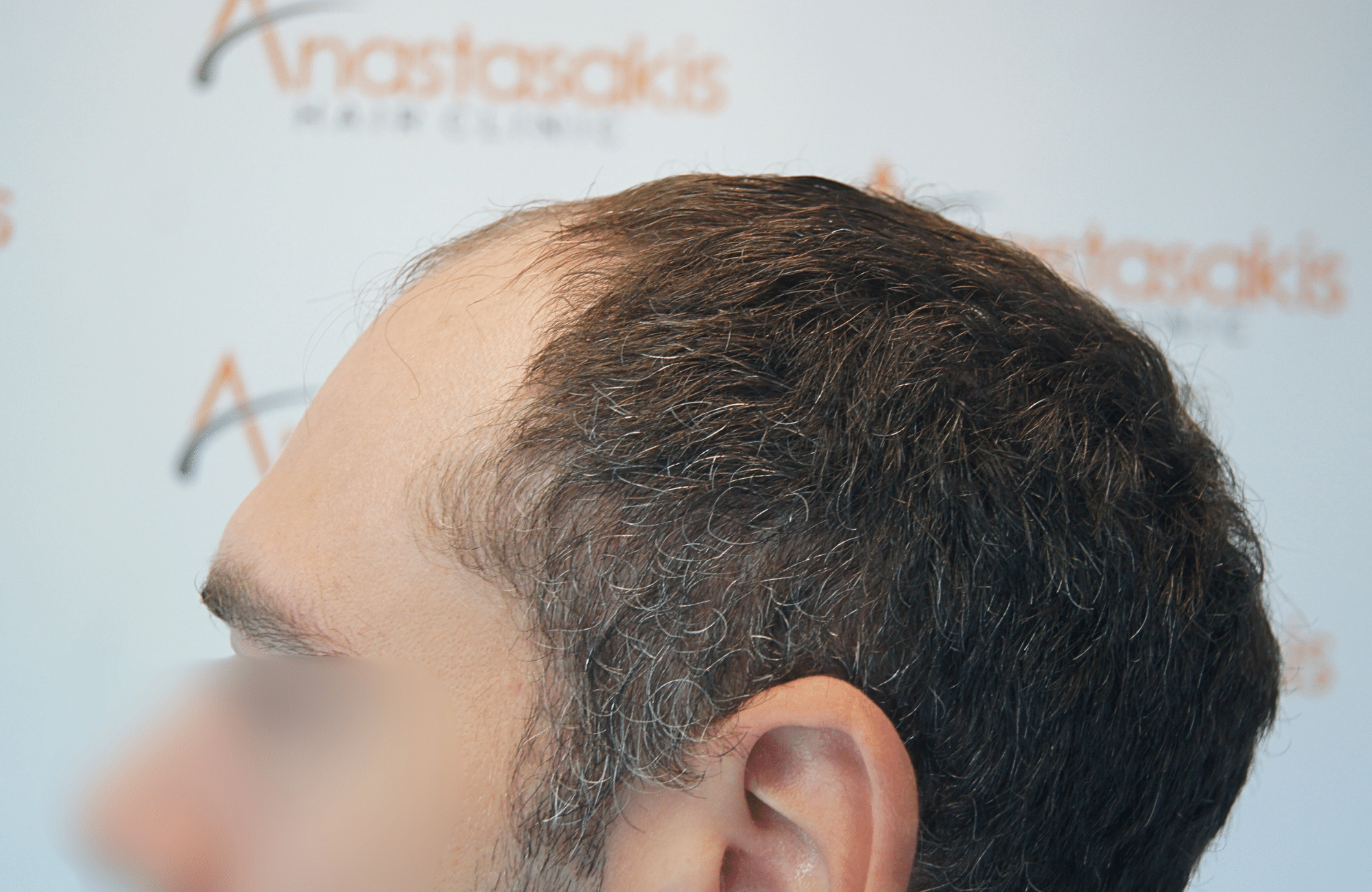 hair transplant result 2000 fus before