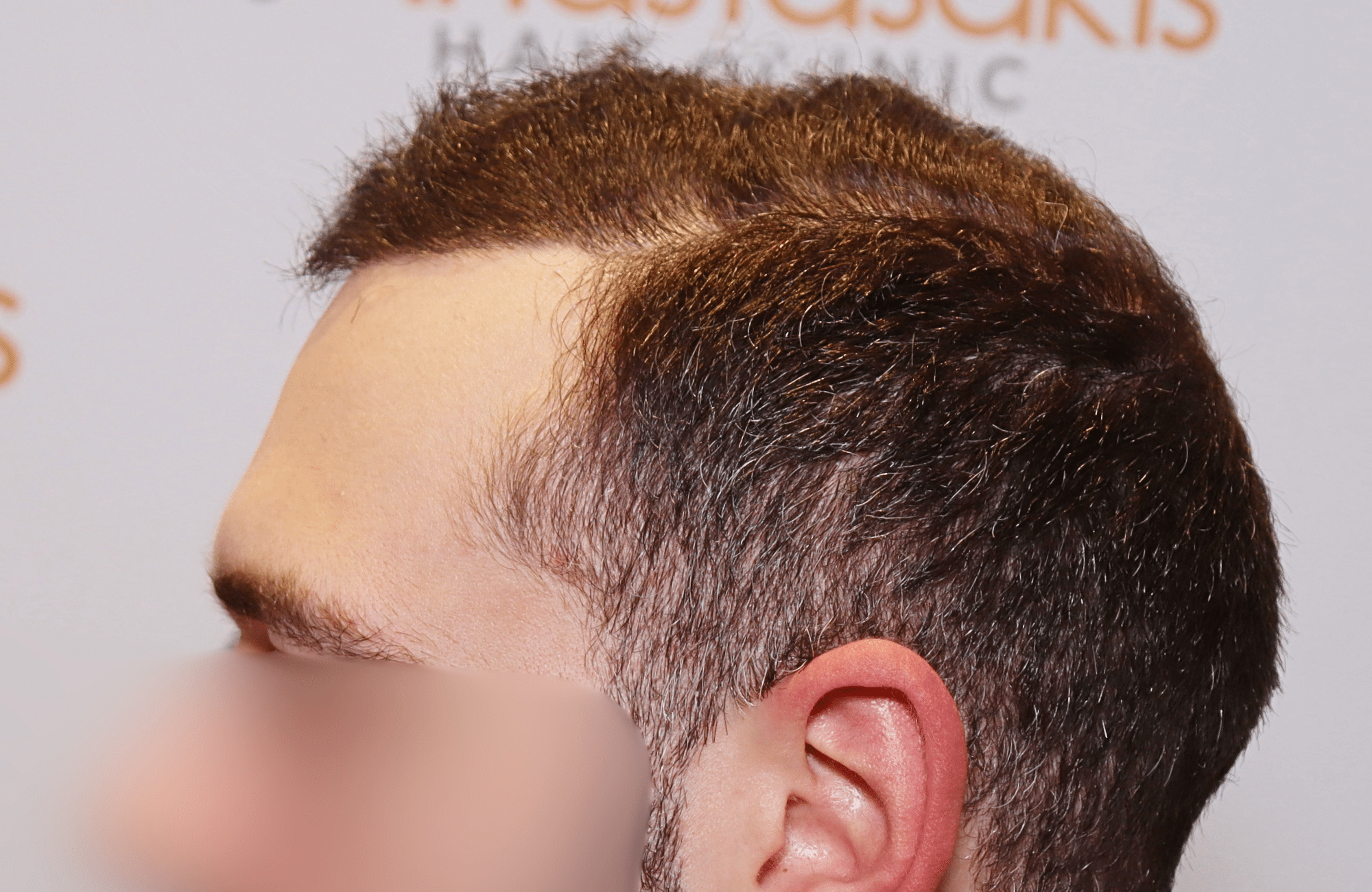 hair transplant result 2000 fus after