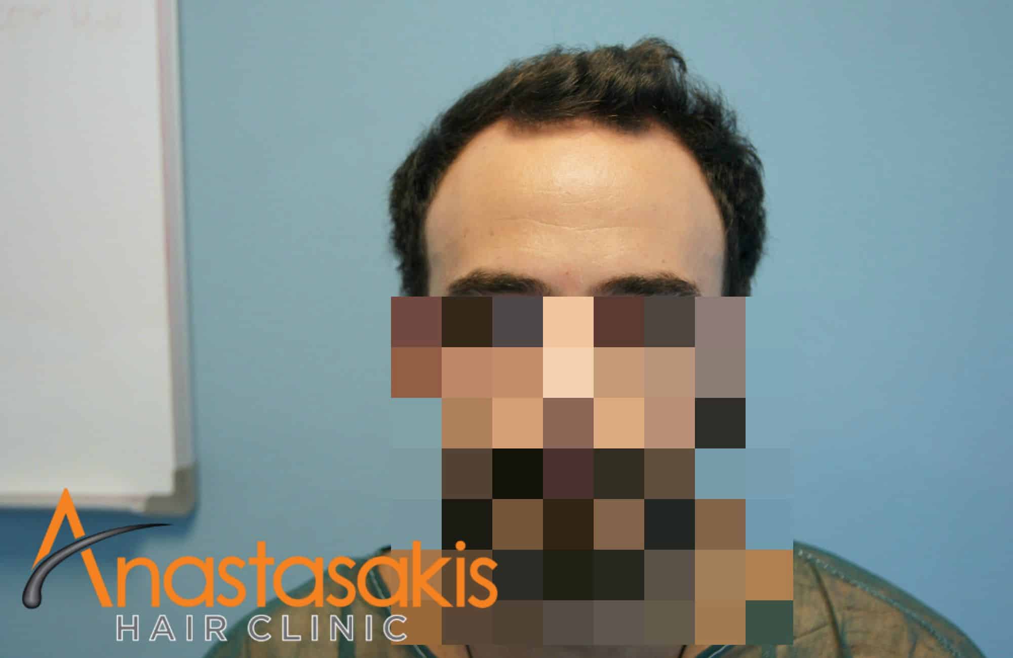 fullface ασθενους πριν τη μεταμοσχευση μαλλιων με 2500 fus