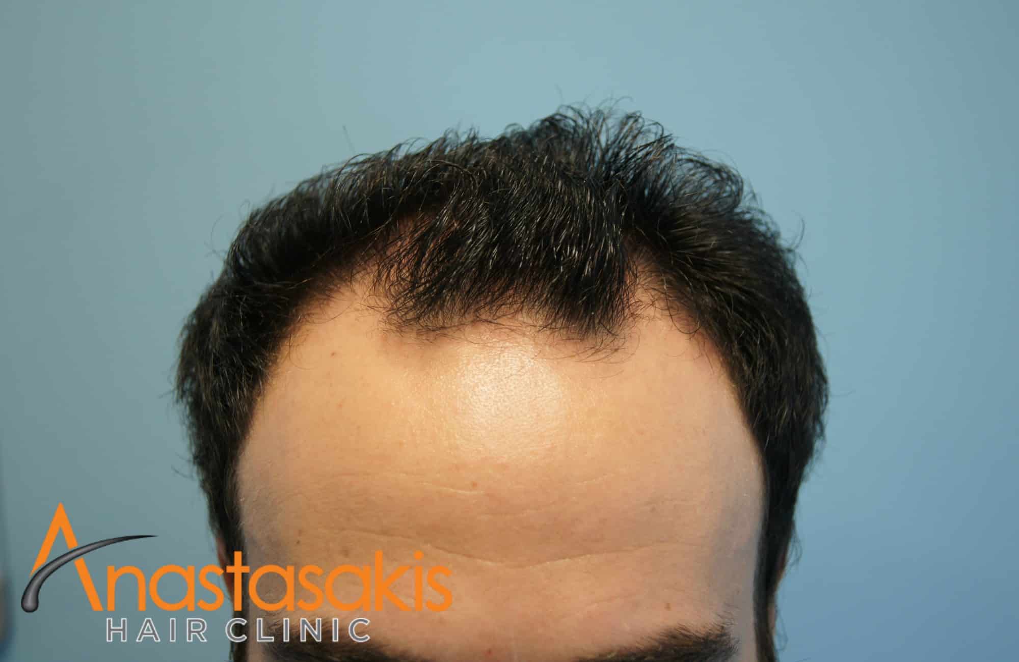 hairline ασθενους πριν τη μεταμοσχευση μαλλιων με 2500 fus