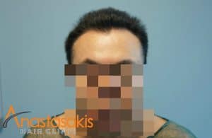 ασθενης πριν τη μεταμοσχευση μαλλιων με 1540fus fullface
