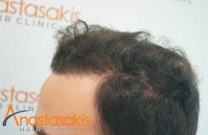 δεξι προφιλ 1 ασθενους μετα τη μεταμοσχευση μαλλιων με 2500 fus