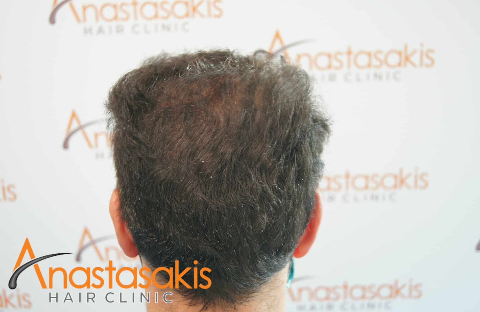 vertex ασθενους μετα τη μεταμοσχευση μαλλιων με 2500 fus