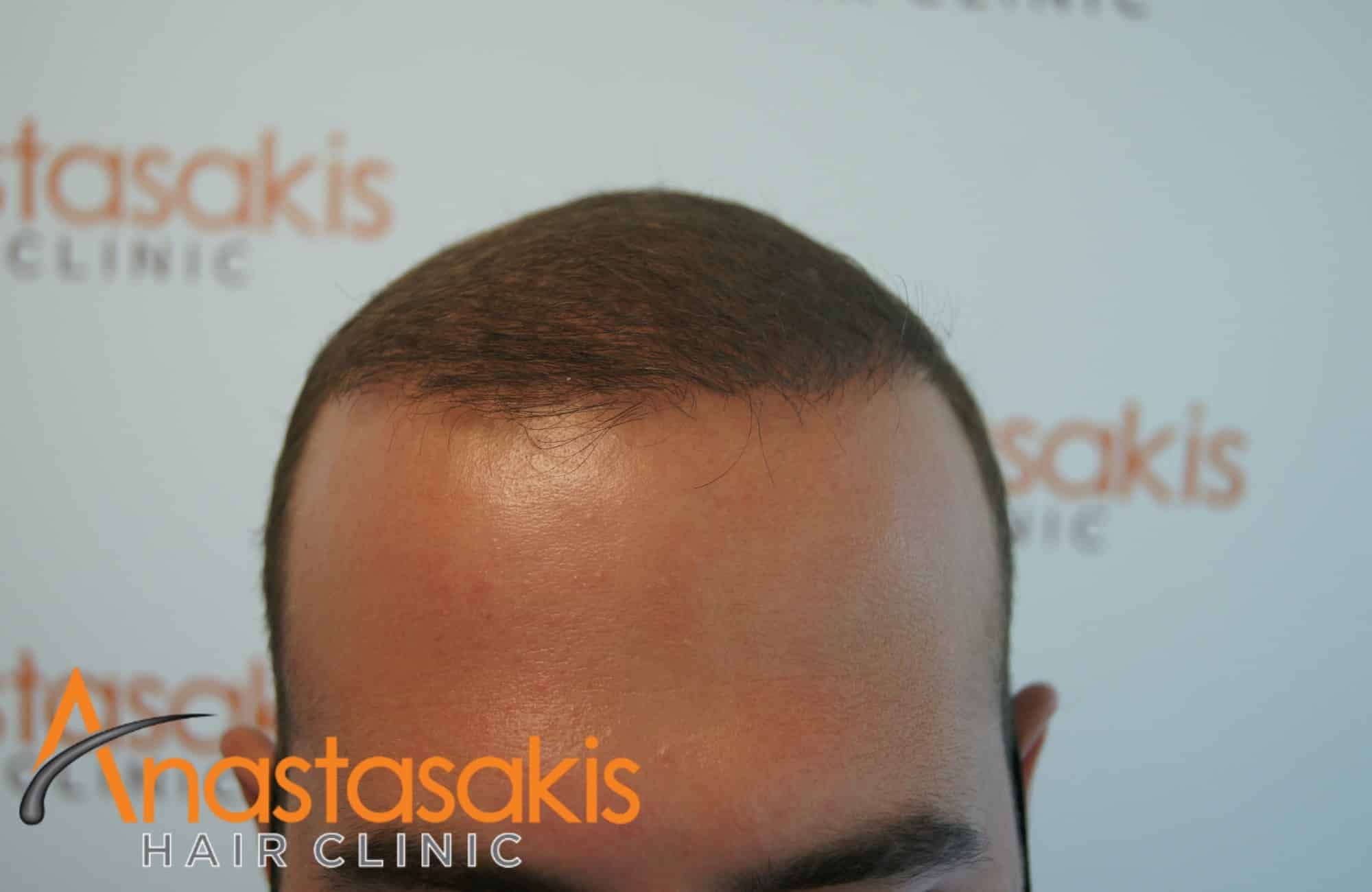 hairline ασθενους μετα τη μεταμόσχευσή μαλλιών με 3000 fus