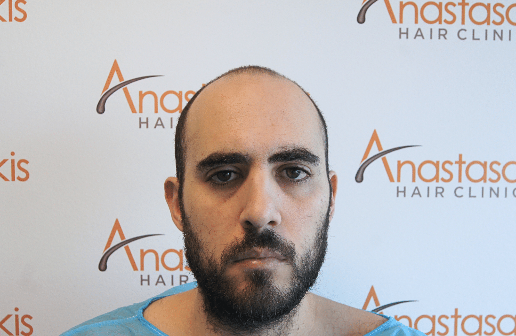 hair transplant result