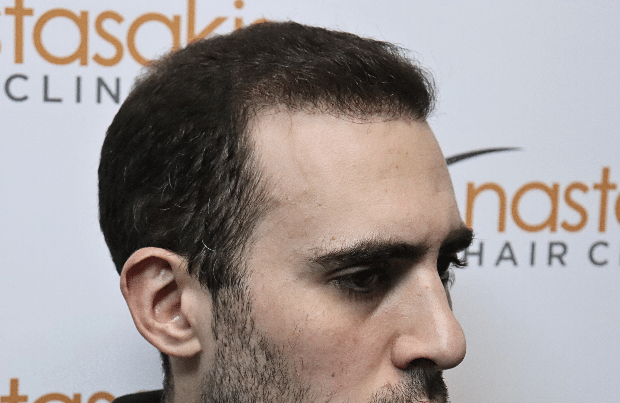 hair transplant result