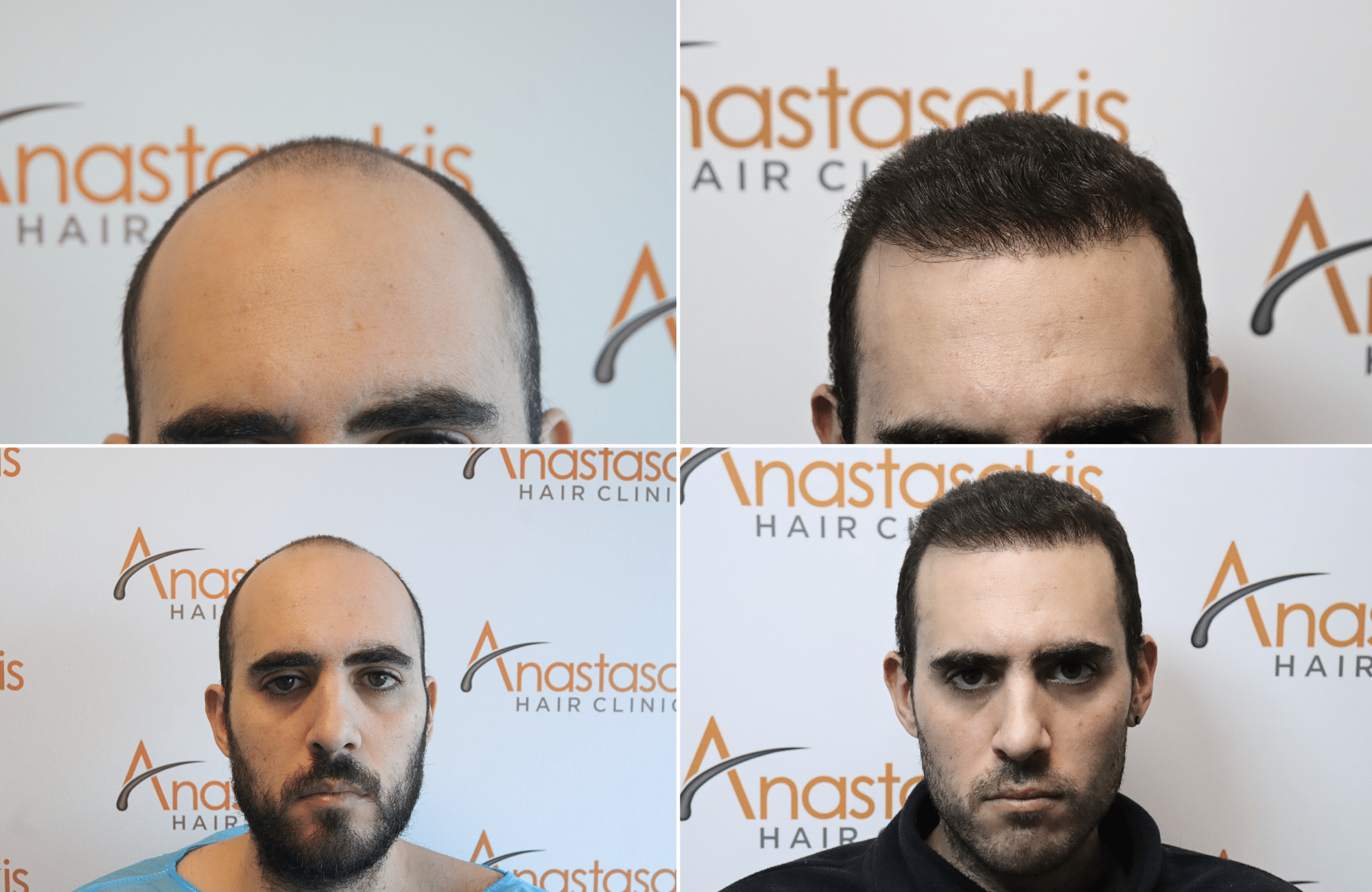 https://www.anastasakishairclinic.gr/portfolio/apotelesma-me-3500-fus-4/