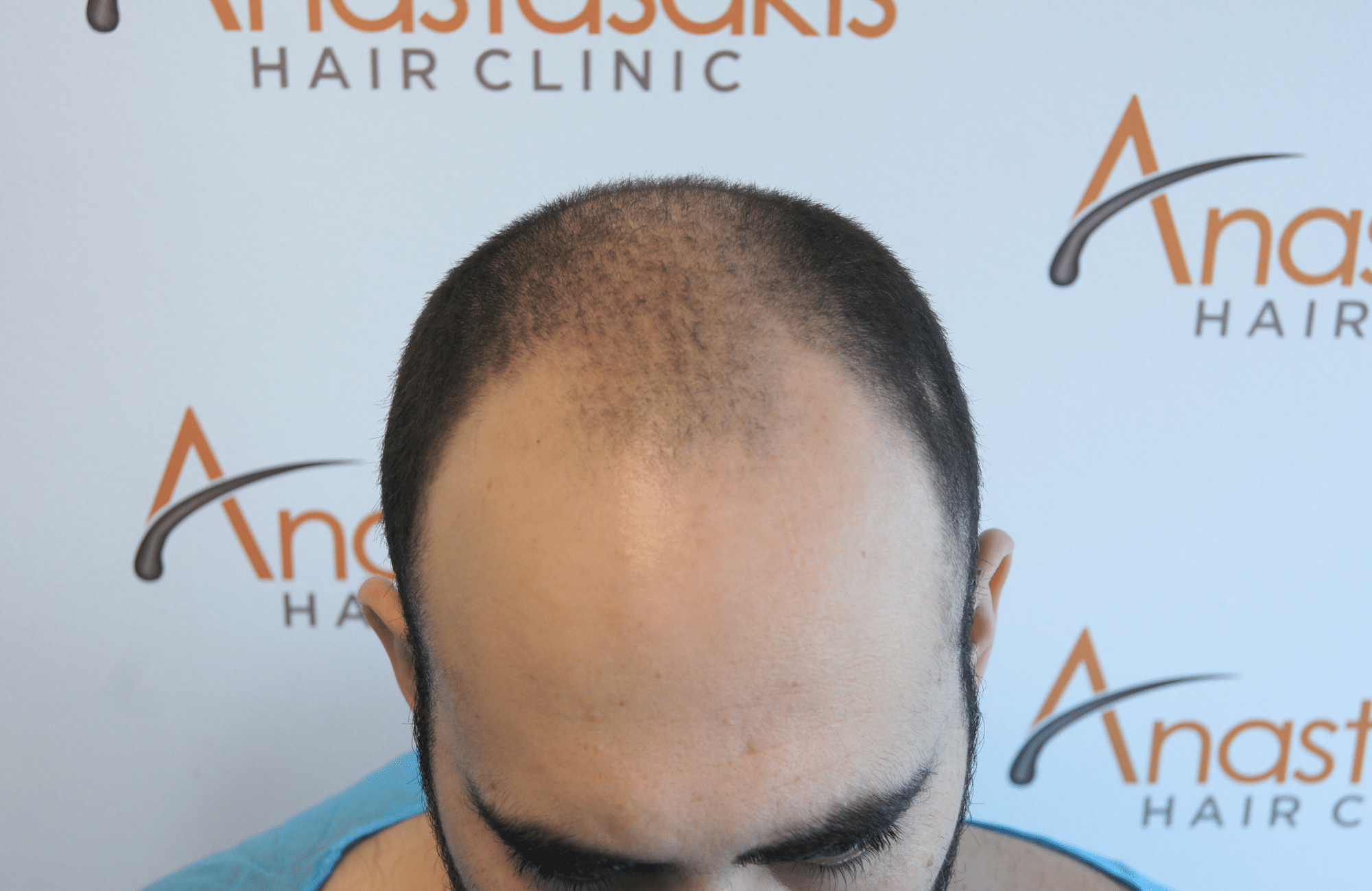 hair transplant result