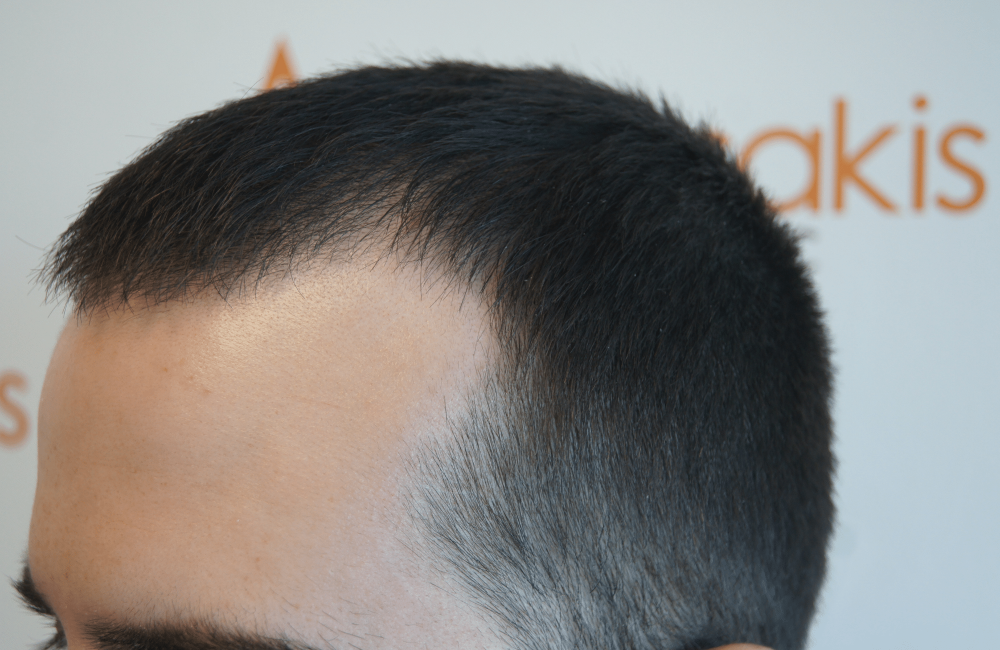 hair transplant result 2000 fus (2)