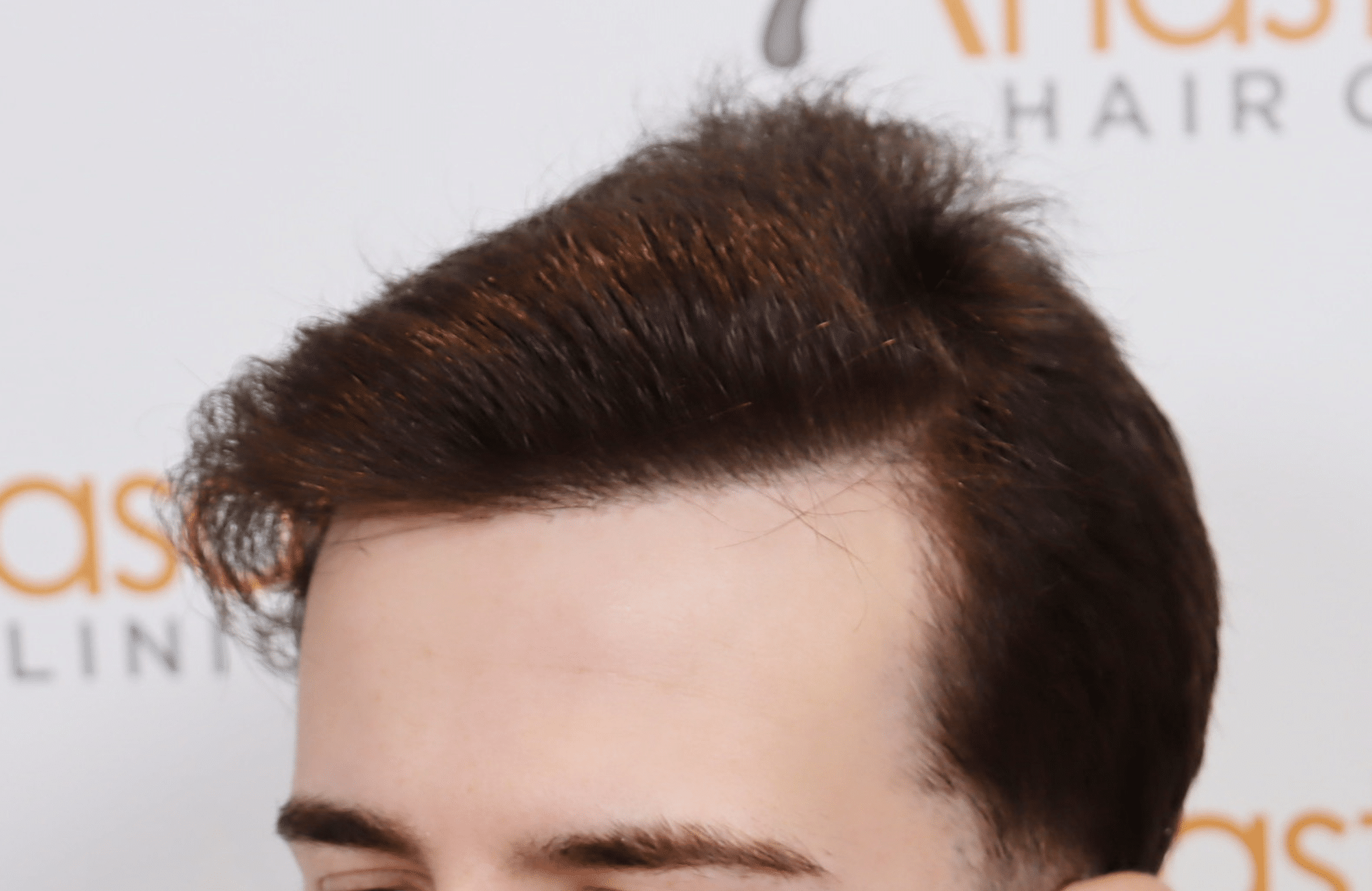 hair transplant result 2000 fus (3)