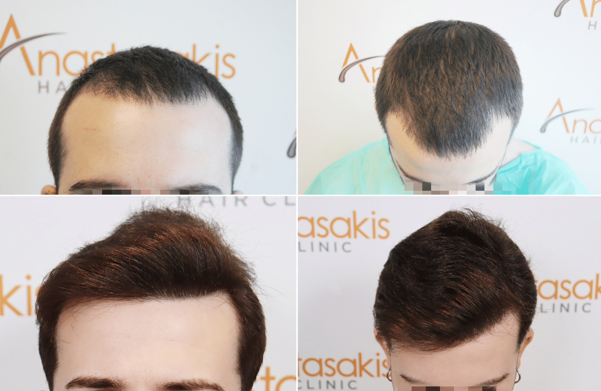 https://www.anastasakishairclinic.gr/portfolio/apotelesma-me-fue-2000-fus-2/