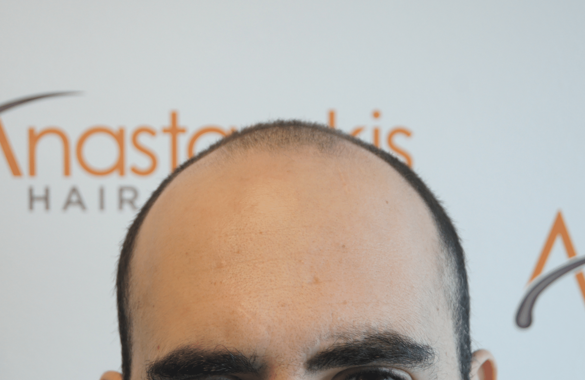 hair transplant result