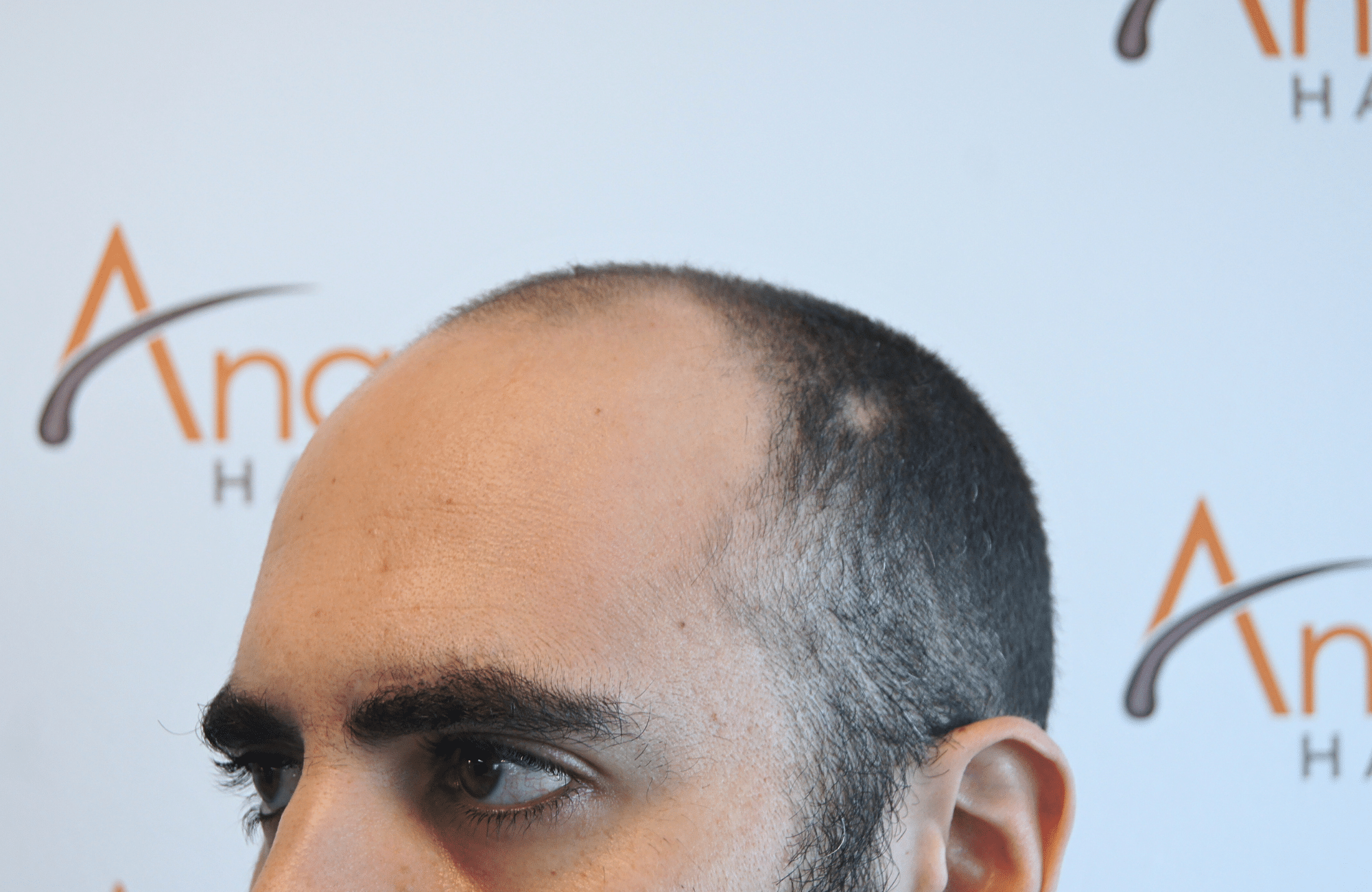 hair transplant result