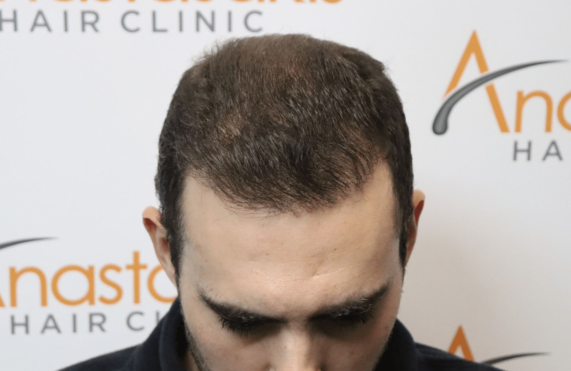 hair transplant result