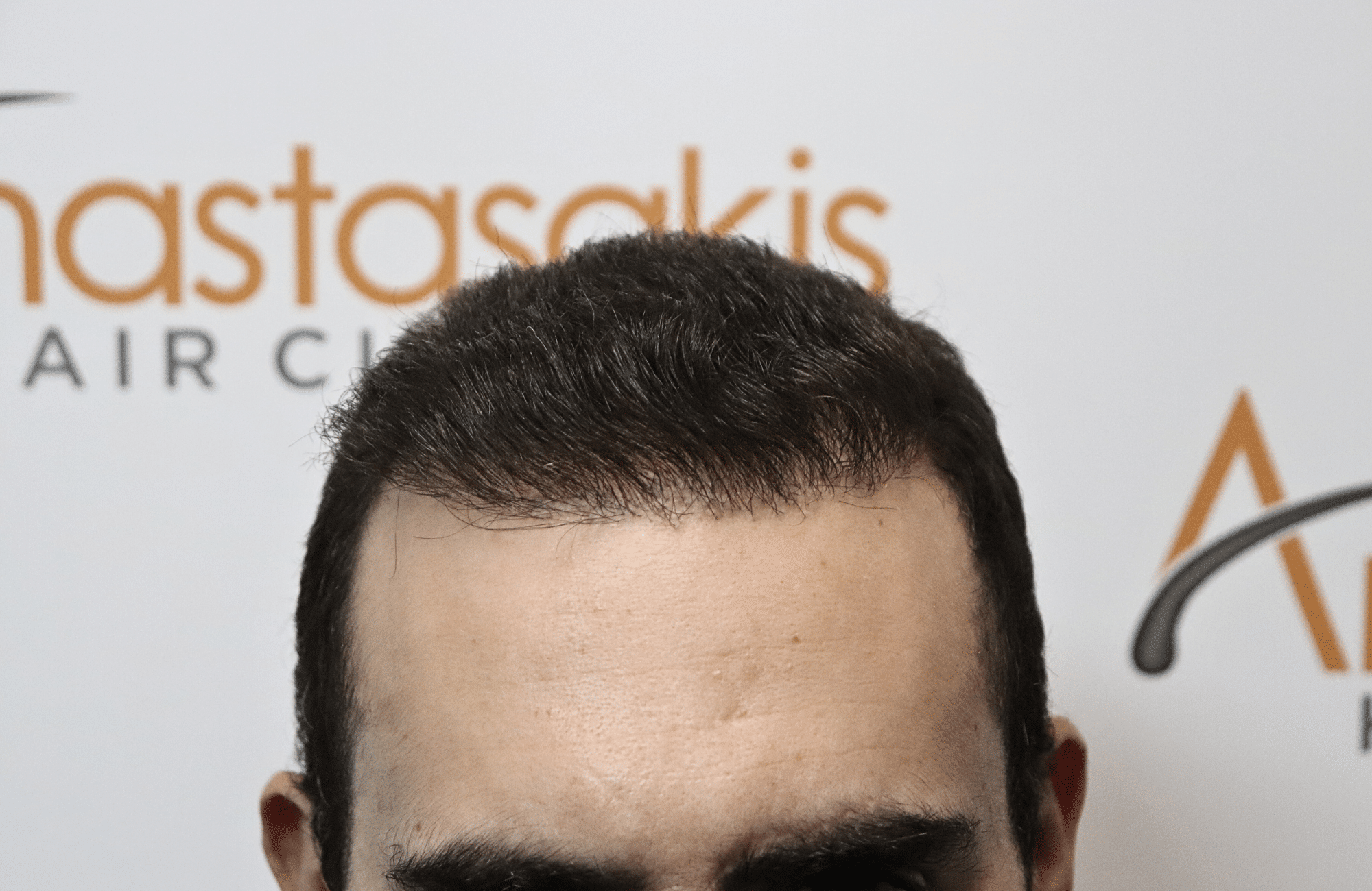 hair transplant result
